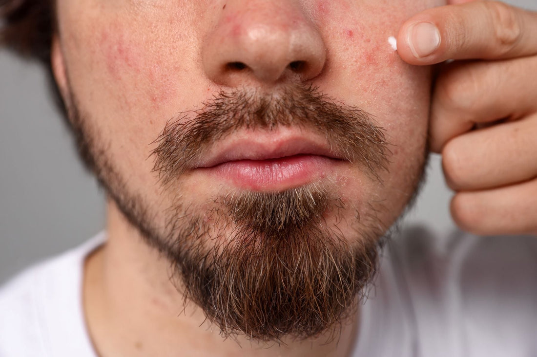 Can Beard Oil Cause Acne?