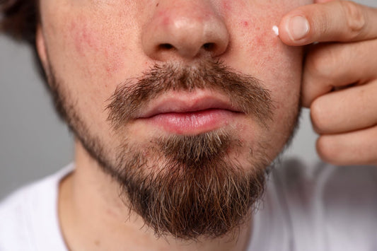 Can Beard Oil Cause Acne?